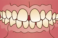 前歯のすきっ歯