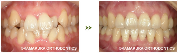 デコボコの歯並び症例