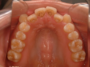 術前の歯並び